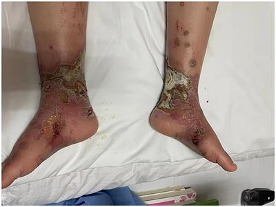 Case report: Spinal cord stimulation in the treatment of pediatric erythromelalgia